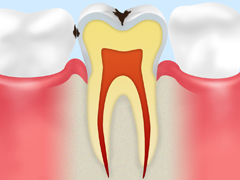 ［C1］エナメル質のむし歯