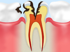 ［C2］象牙質のむし歯