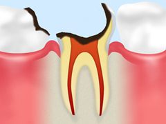 ［C3］神経のむし歯
