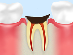 ［C4］歯根のむし歯
